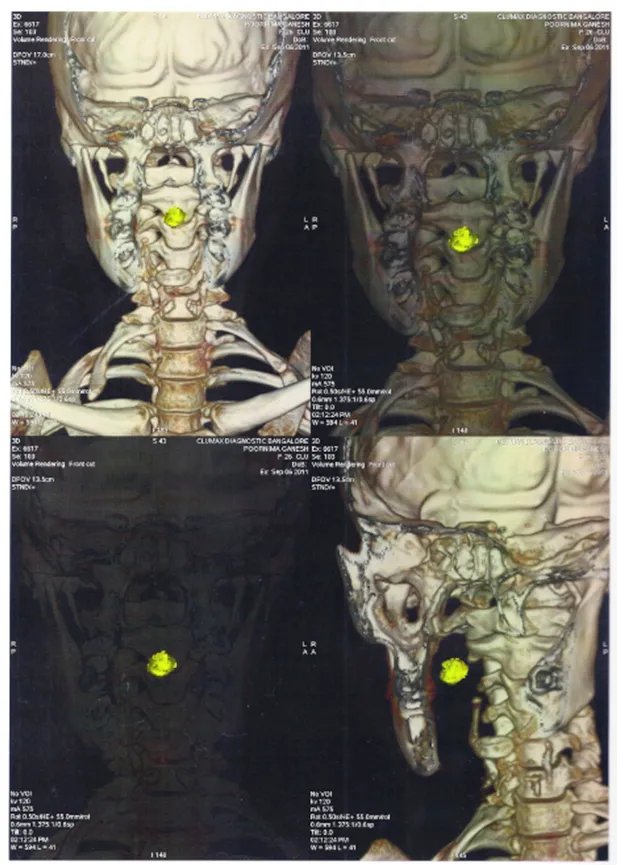 Scan showing the sudden appearance of the foreign body (green-colored stone) in the oral cavity of the individual.